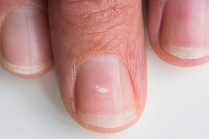 O czym mogą świadczyć białe plamki na paznokciach?
