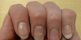 Czym są bruzdy na paznokciach?