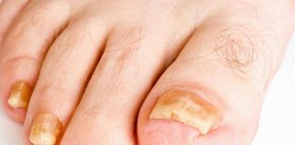 grzybica paznokci - co do niej prowadzi?